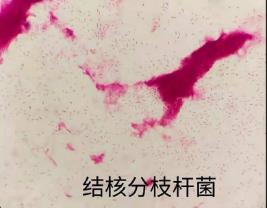 結(jié)核分枝桿菌的生物學(xué)特性、培養(yǎng)方法及應(yīng)用