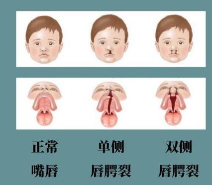 口腔微生物與唇腭裂及唇腭裂患者易感疾病有何關(guān)聯(lián)（一）